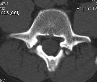 Pars Defect Bilateral CT